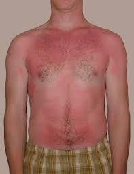 Zonnebrand